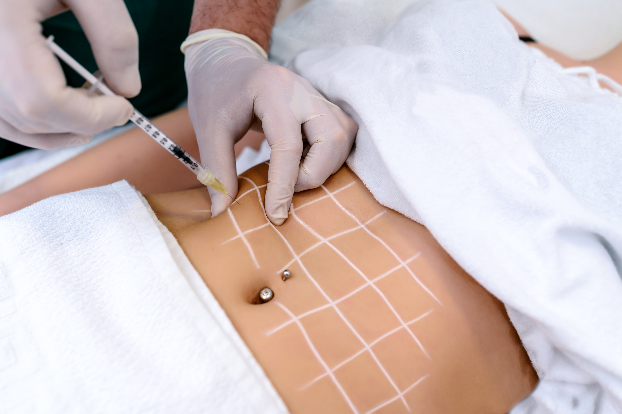 Woman's having lipolysis treatment